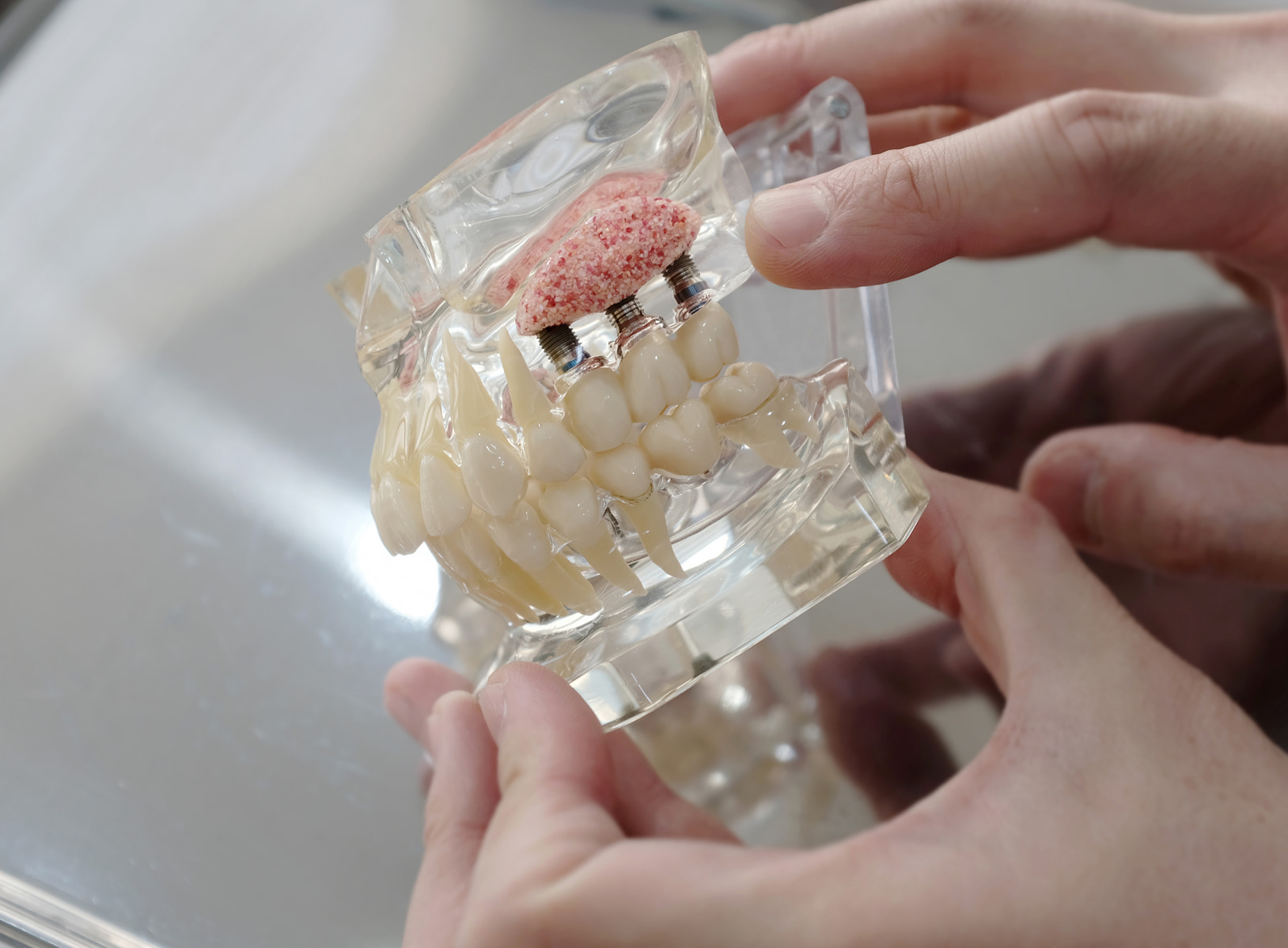 Bone grafting for dental implants to restore jawbone and support implant stability