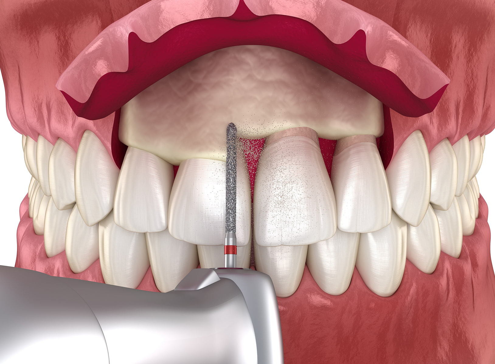 Crown lengthening procedure to improve tooth function and smile aesthetics