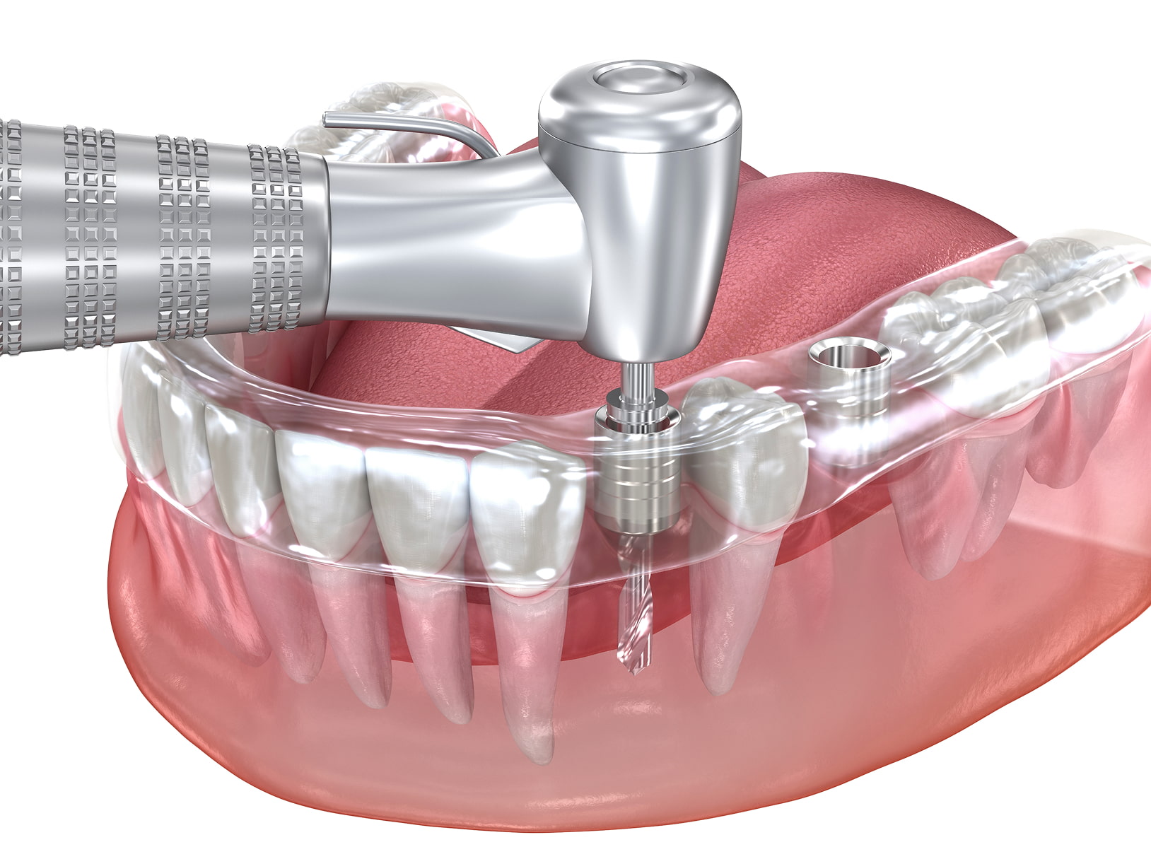 Guided implant surgery using 3D imaging for precise dental implant placement