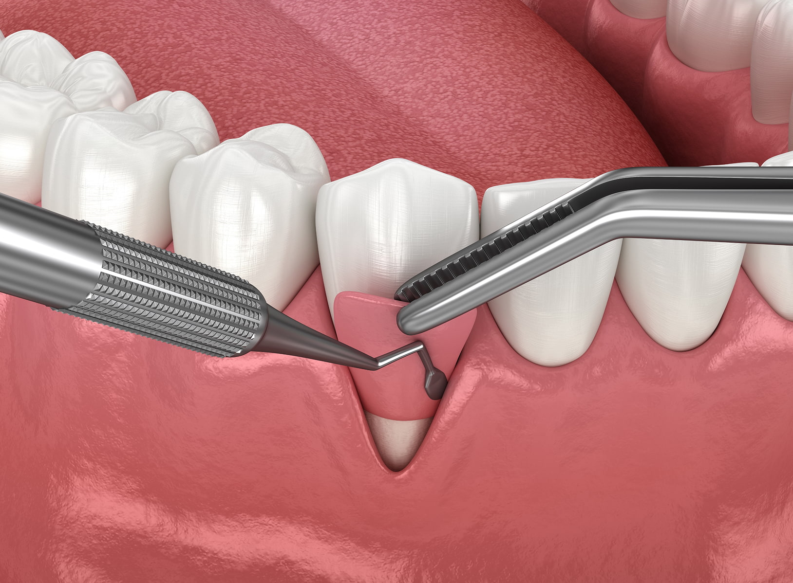Gum grafting procedure to restore gum tissue and protect teeth