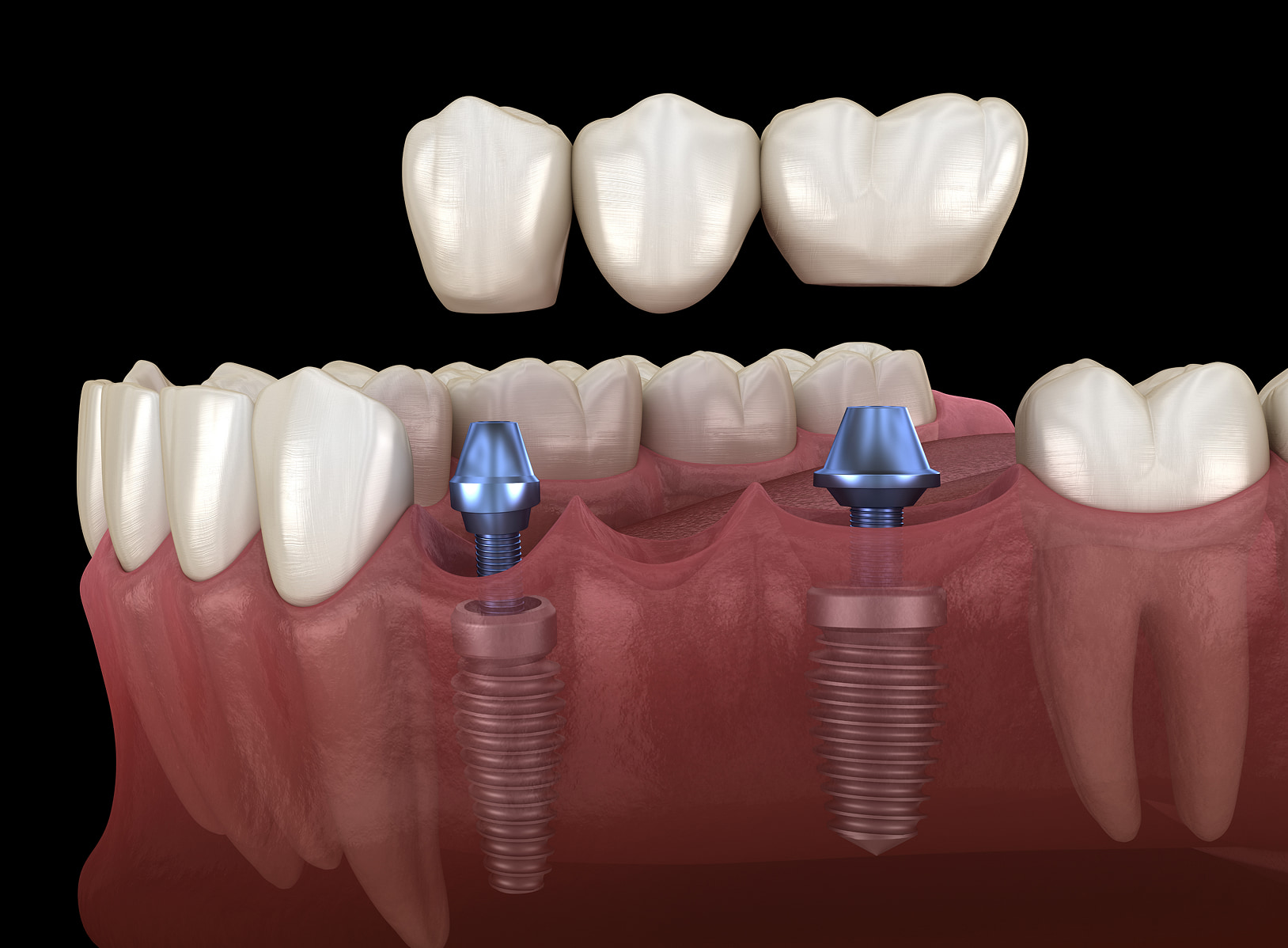 Implant-supported bridges restore multiple missing teeth and prevent oral health problems