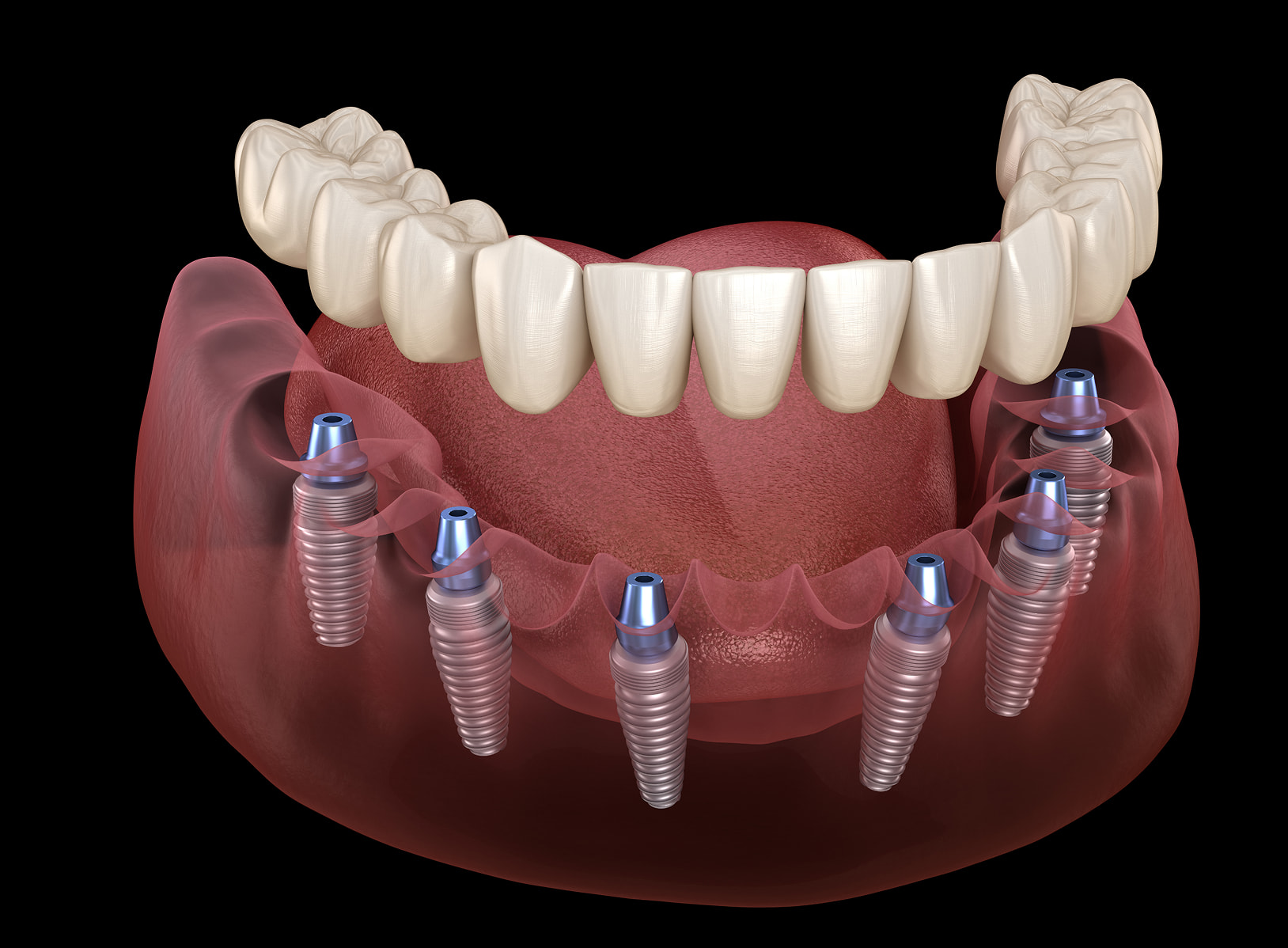 Implant-supported dentures for stable and comfortable tooth replacement