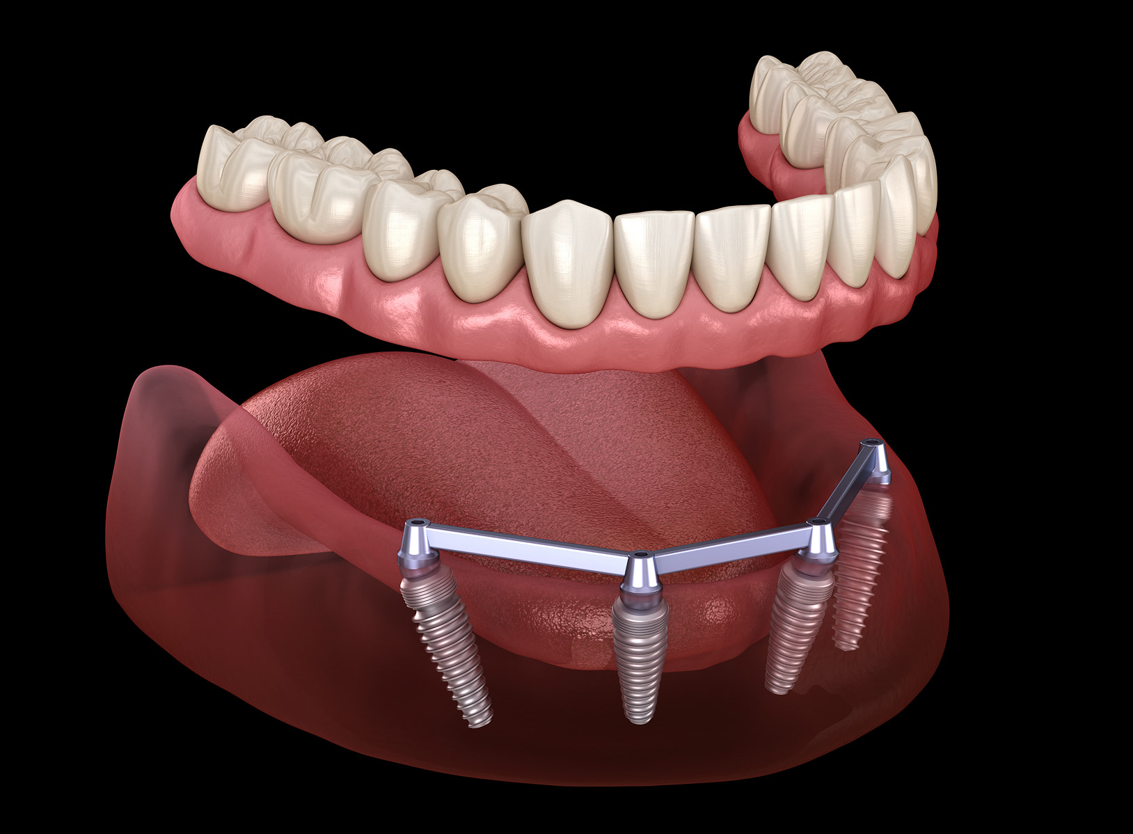 Reasons to choose FORMA for implant-supported dentures in Illinois