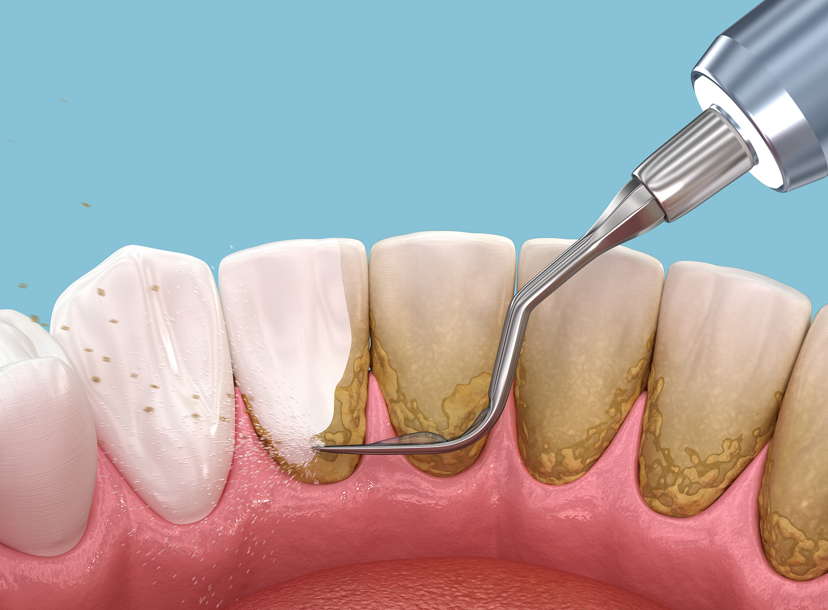 Scaling and root planing to treat gum disease and clean below the gumline