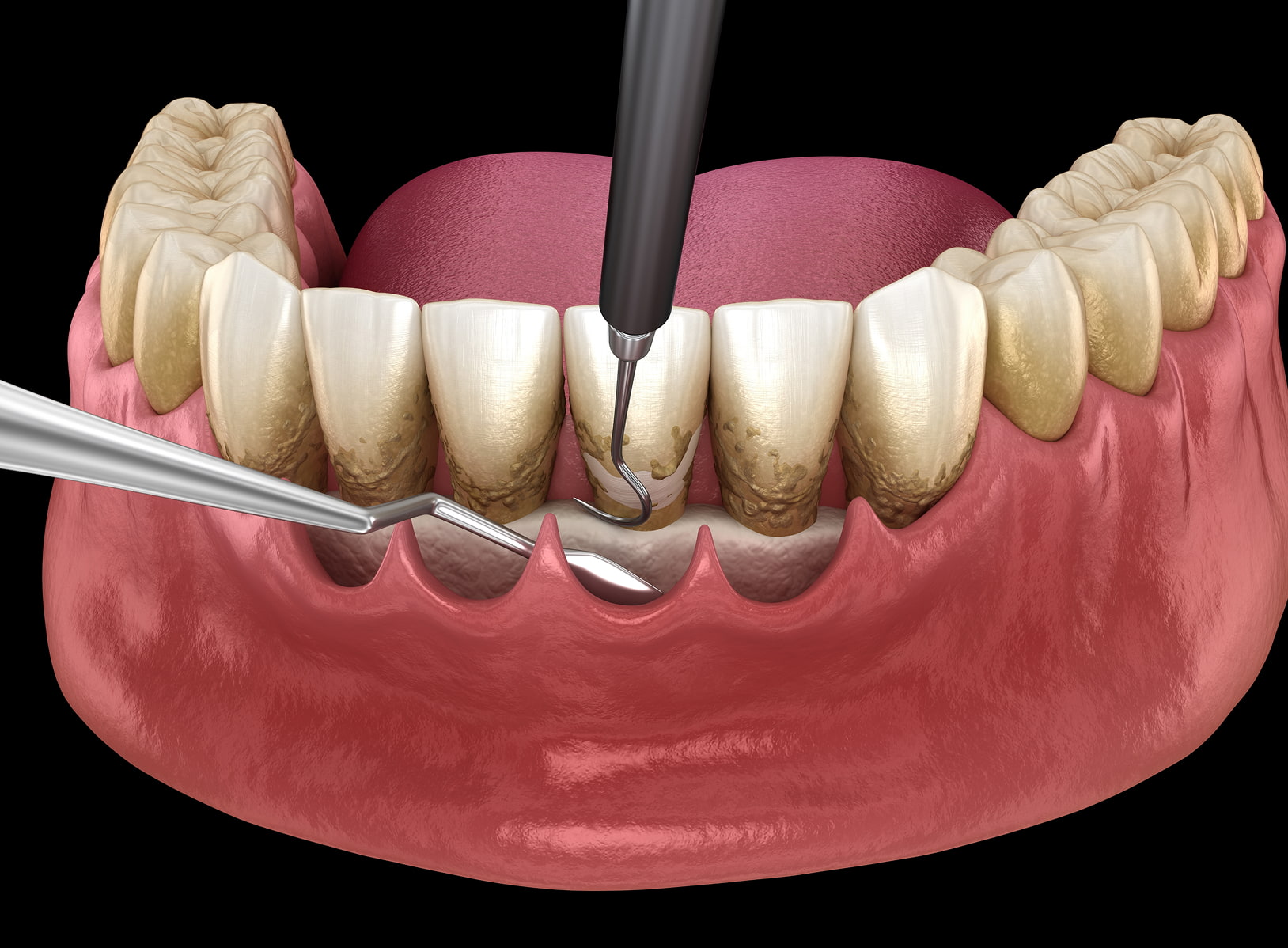 Advanced technology for precise and comfortable deep dental cleanings