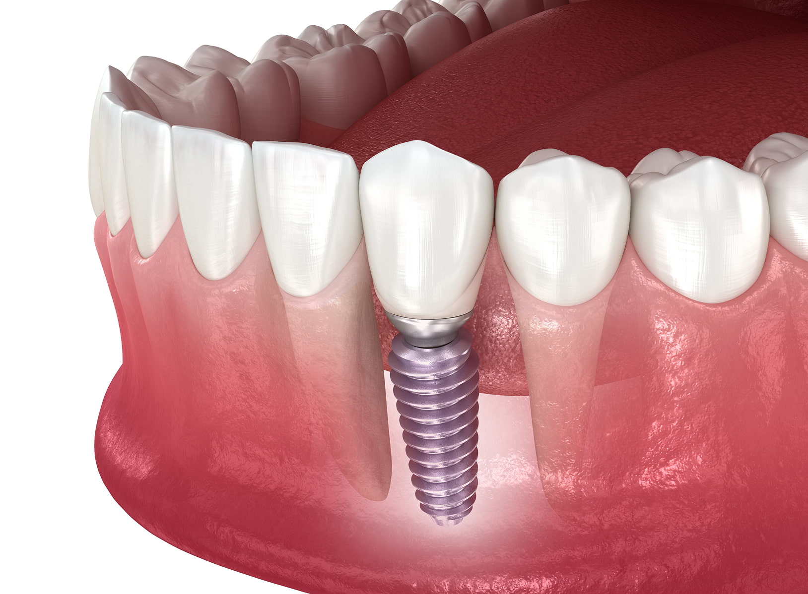 Step-by-step dental implant process from consultation to final crown for a natural, secure smile